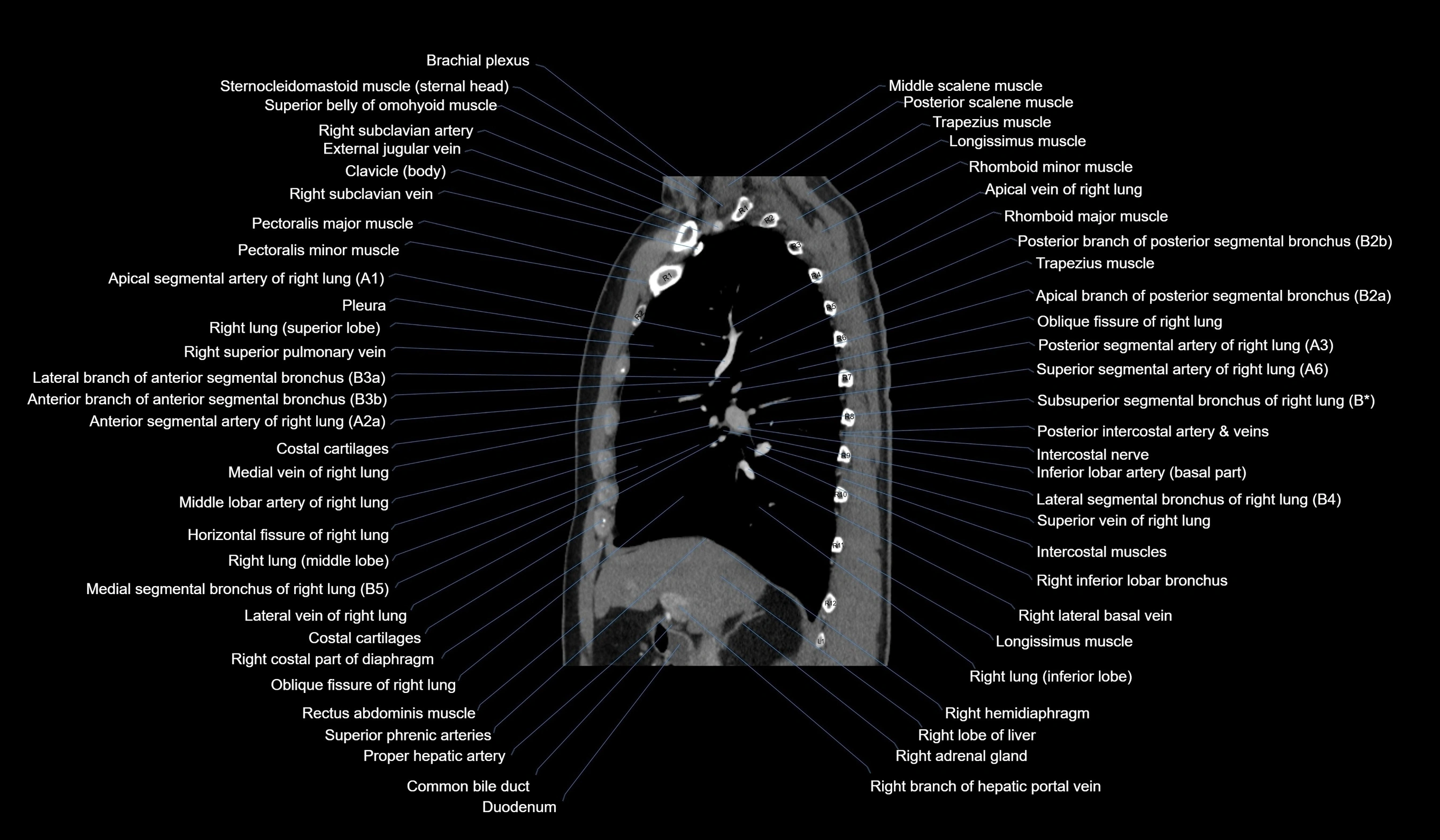 CT chest (thorax) soft tissue window labelled sagittal cross sectional anatomy radiology image-00055.webp